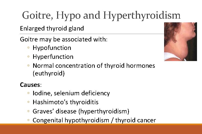 Goitre, Hypo and Hyperthyroidism Enlarged thyroid gland Goitre may be associated with: ◦ Hypofunction