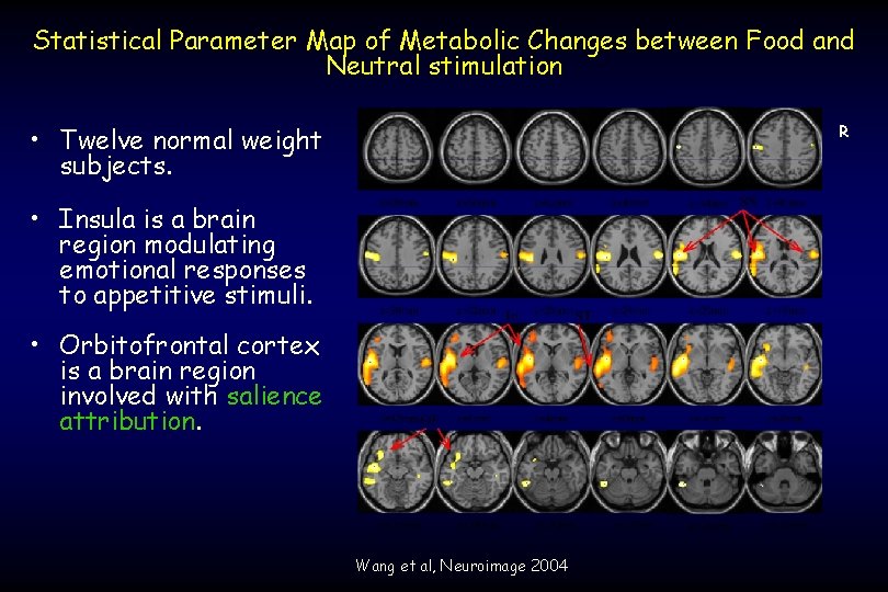 Statistical Parameter Map of Metabolic Changes between Food and Neutral stimulation • Twelve normal