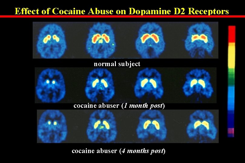 Effect of Cocaine Abuse on Dopamine D 2 Receptors normal subject cocaine abuser (1