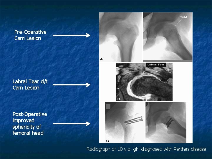 Pre-Operative Cam Lesion Labral Tear d/t Cam Lesion Post-Operative improved sphericity of femoral head