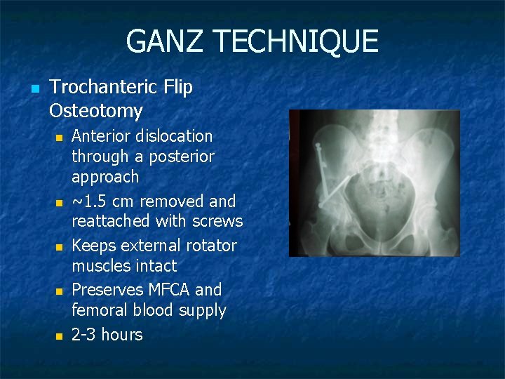 GANZ TECHNIQUE n Trochanteric Flip Osteotomy n n n Anterior dislocation through a posterior