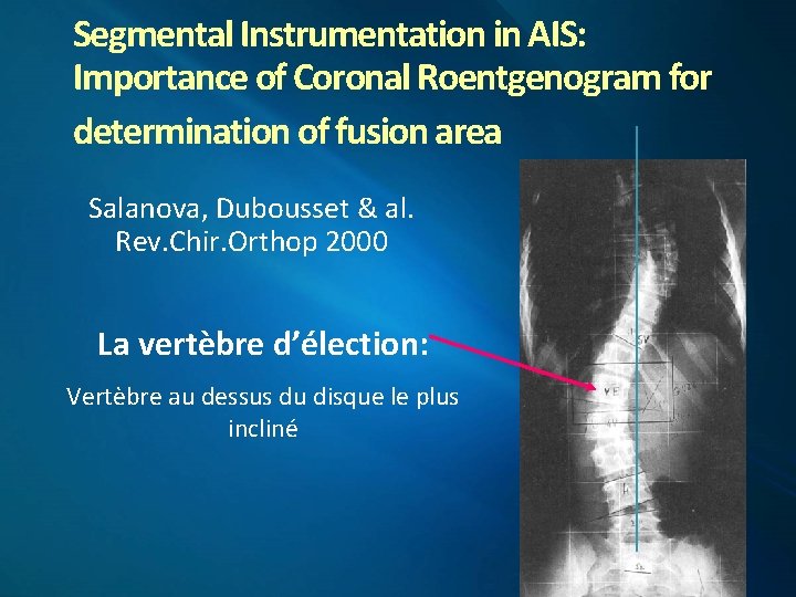 Segmental Instrumentation in AIS: Importance of Coronal Roentgenogram for determination of fusion area Salanova,