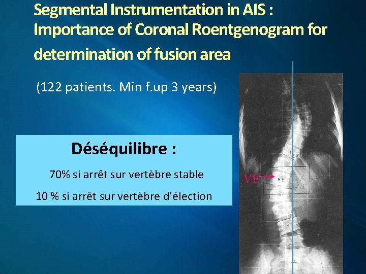 Segmental Instrumentation in AIS : Importance of Coronal Roentgenogram for determination of fusion area