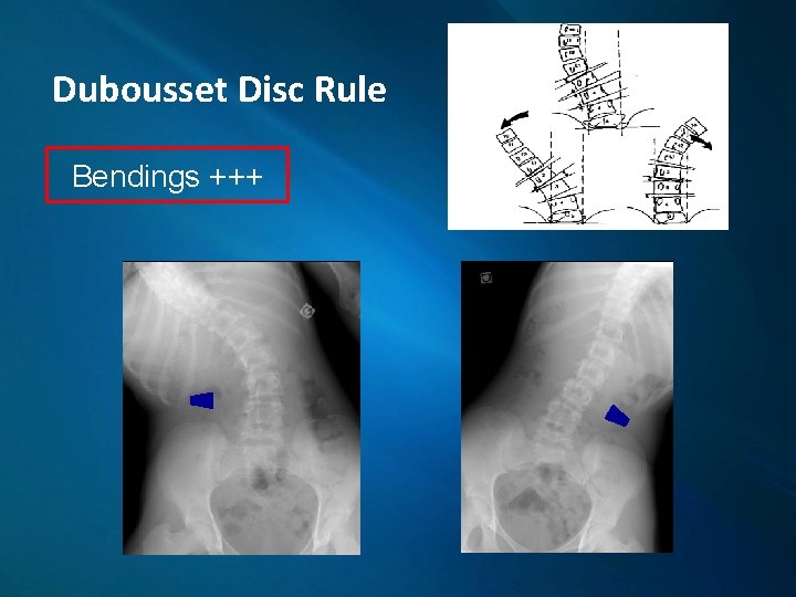 Dubousset Disc Rule Bendings +++ 