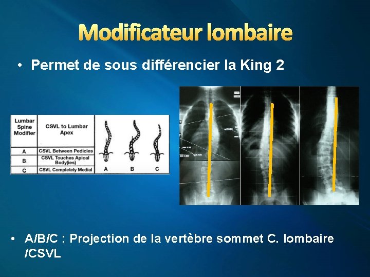 Modificateur lombaire • Permet de sous différencier la King 2 • A/B/C : Projection