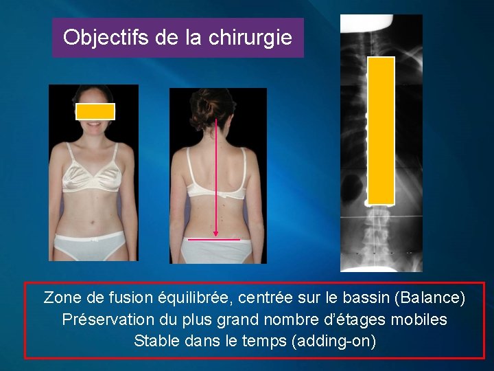 Objectifs de la chirurgie Zone de fusion équilibrée, centrée sur le bassin (Balance) Préservation