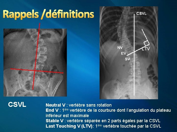 Rappels /définitions LTV CSVL Neutral V : vertèbre sans rotation End V : 1ère