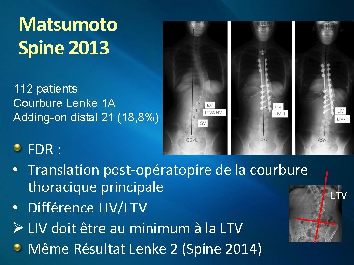 Matsumoto Spine 2013 112 patients Courbure Lenke 1 A Adding-on distal 21 (18, 8%)