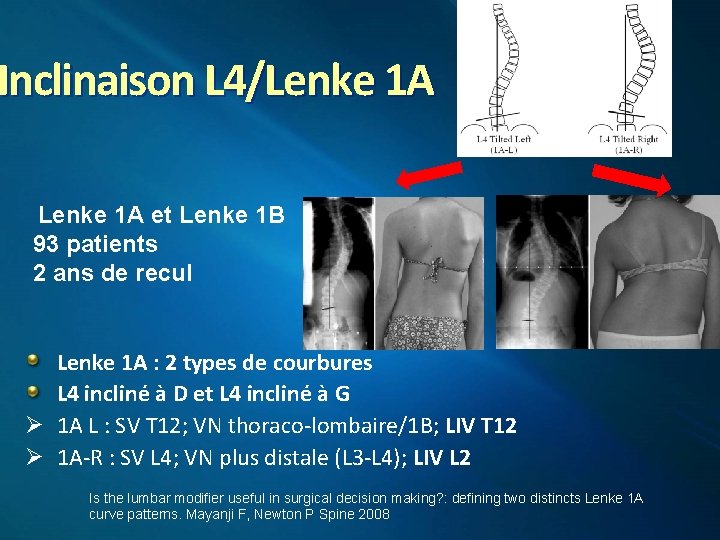 Inclinaison L 4/Lenke 1 A et Lenke 1 B 93 patients 2 ans de