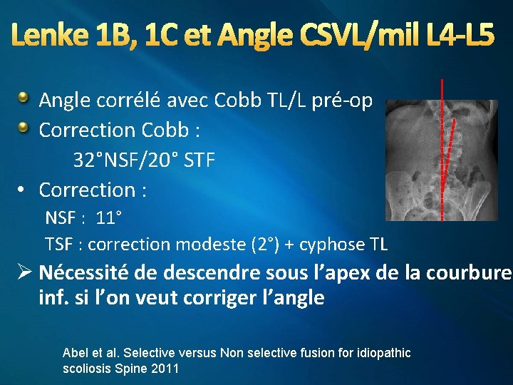 Lenke 1 B, 1 C et Angle CSVL/mil L 4 -L 5 Angle corrélé