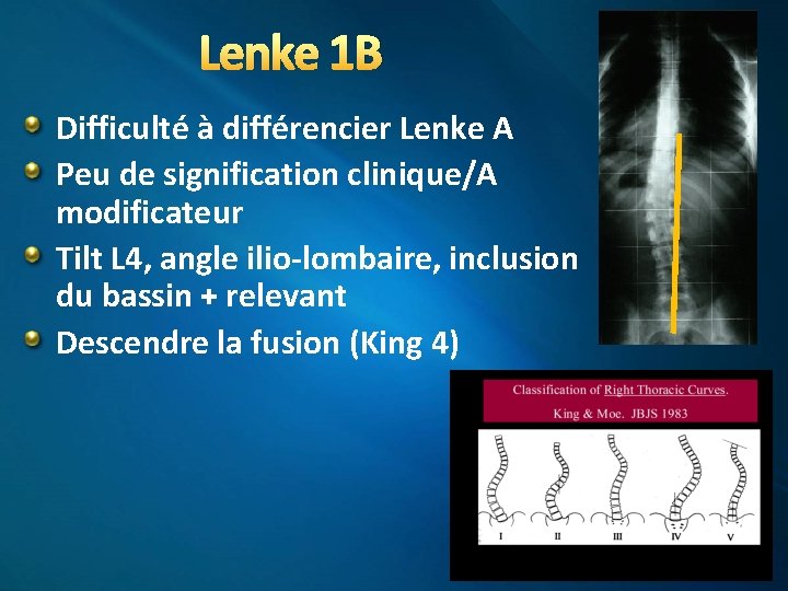 Lenke 1 B Difficulté à différencier Lenke A Peu de signification clinique/A modificateur Tilt