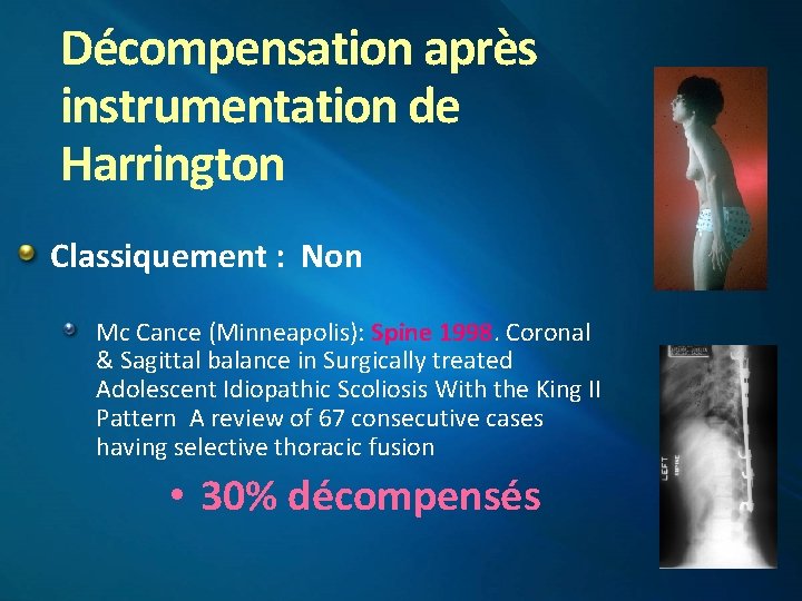 Décompensation après instrumentation de Harrington Classiquement : Non Mc Cance (Minneapolis): Spine 1998. Coronal