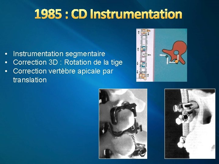 1985 : CD Instrumentation • Instrumentation segmentaire • Correction 3 D : Rotation de