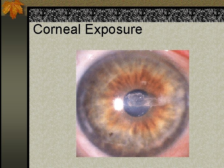 Corneal Exposure 
