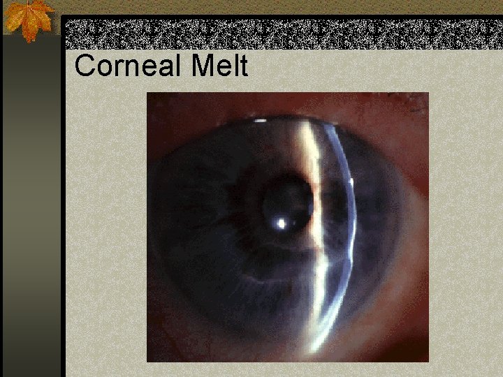 Corneal Melt 