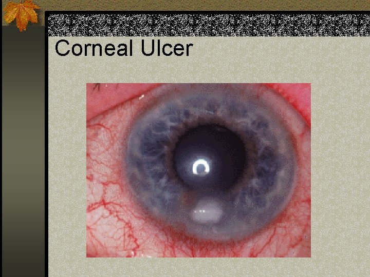 Corneal Ulcer 