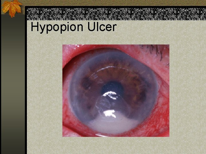 Hypopion Ulcer 