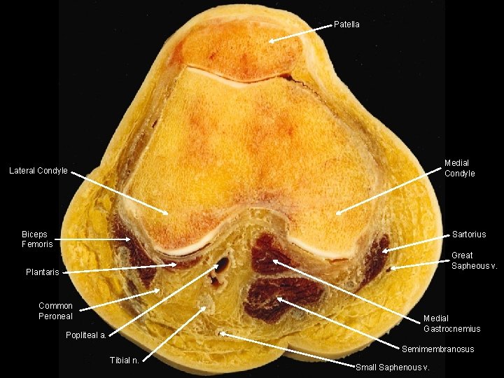 Patella Medial Condyle Lateral Condyle Biceps Femoris Sartorius Great Sapheous v. Plantaris Common Peroneal