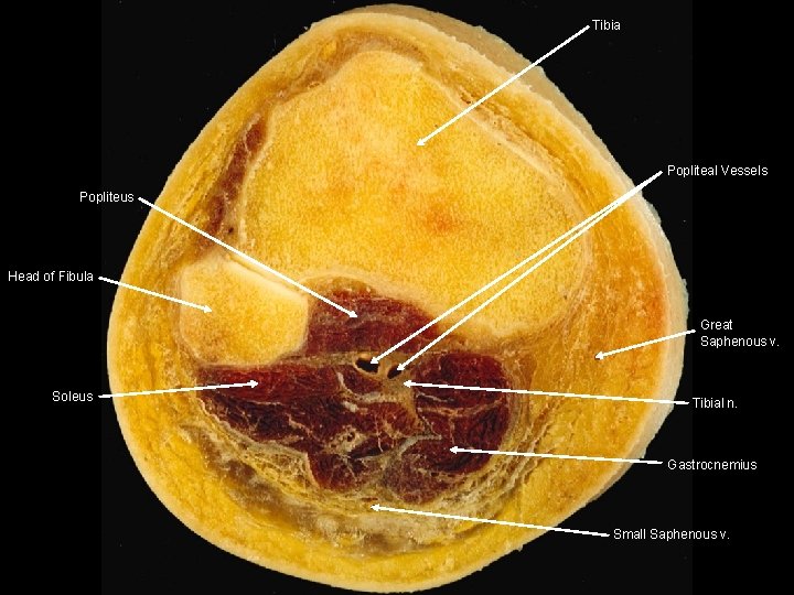 Tibia Popliteal Vessels Popliteus Head of Fibula Great Saphenous v. Soleus Tibial n. Gastrocnemius Tibia Popliteal Vessels Popliteus Head of Fibula Great Saphenous v. Soleus Tibial n. Gastrocnemius