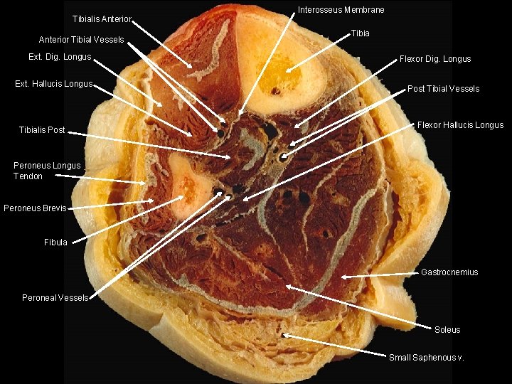 Tibialis Anterior Tibial Vessels Ext. Dig. Longus Ext. Hallucis Longus Tibialis Post Interosseus Membrane Tibialis Anterior Tibial Vessels Ext. Dig. Longus Ext. Hallucis Longus Tibialis Post Interosseus Membrane