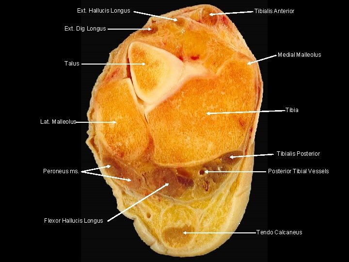 Ext. Hallucis Longus Tibialis Anterior Ext. Dig Longus Medial Malleolus Talus Tibia Lat. Malleolus Ext. Hallucis Longus Tibialis Anterior Ext. Dig Longus Medial Malleolus Talus Tibia Lat. Malleolus