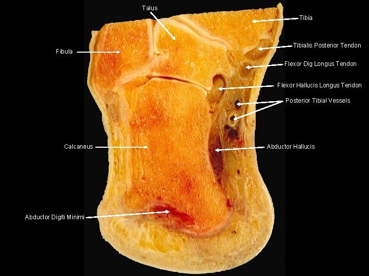 Talus Tibia Fibula Tibialis Posterior Tendon Flexor Dig Longus Tendon Flexor Hallucis Longus Tendon Talus Tibia Fibula Tibialis Posterior Tendon Flexor Dig Longus Tendon Flexor Hallucis Longus Tendon