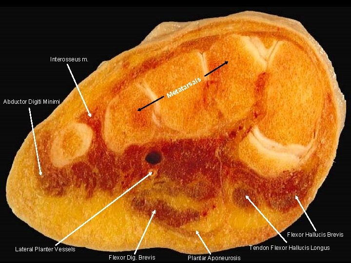 Interosseus m. ls sa tar ta Me Abductor Digiti Minimi Flexor Hallucis Brevis Tendon