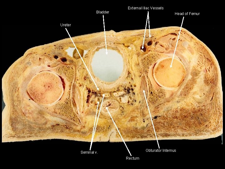 Bladder External Iliac Vessels Head of Femur Ureter Obturator Internus Seminal v. Rectum Bladder External Iliac Vessels Head of Femur Ureter Obturator Internus Seminal v. Rectum