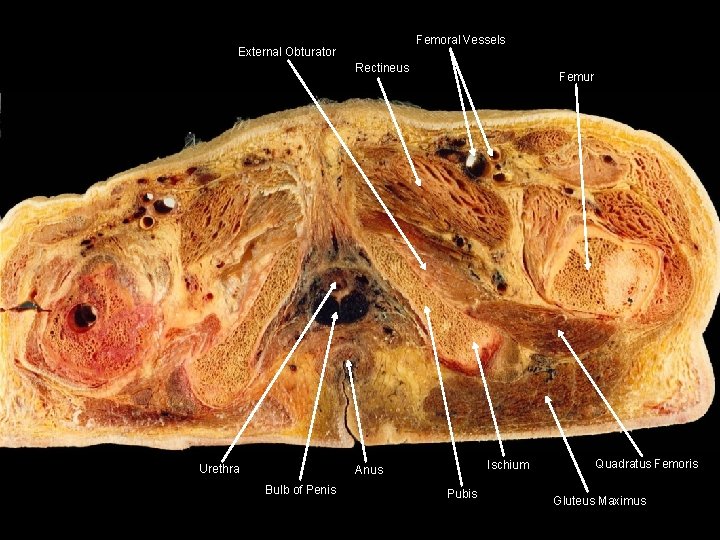 Femoral Vessels External Obturator Rectineus Urethra Femur Ischium Anus Bulb of Penis Pubis Quadratus