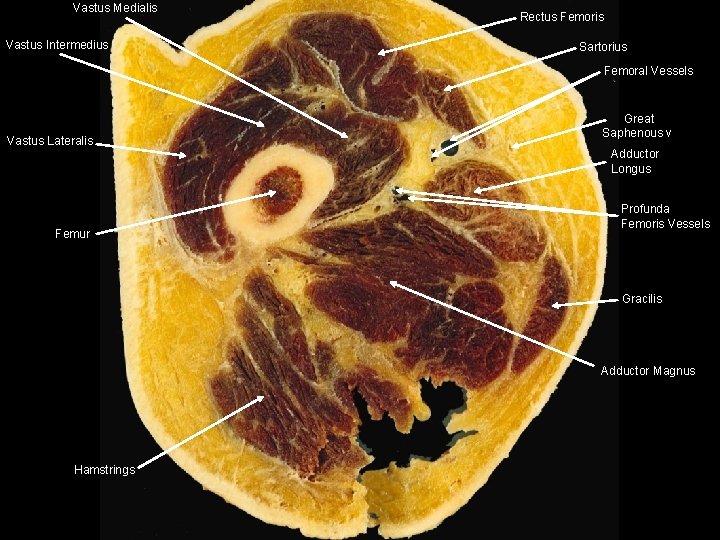 Vastus Medialis Vastus Intermedius Rectus Femoris Sartorius Femoral Vessels Vastus Lateralis Great Saphenous v. Vastus Medialis Vastus Intermedius Rectus Femoris Sartorius Femoral Vessels Vastus Lateralis Great Saphenous v.