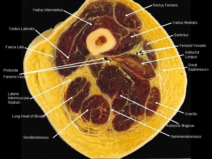 Rectus Femoris Vastus Intermedius Vastus Medialis Vastus Lateralis Sartorius Fascia Lata Femoral Vessels Adductor Rectus Femoris Vastus Intermedius Vastus Medialis Vastus Lateralis Sartorius Fascia Lata Femoral Vessels Adductor