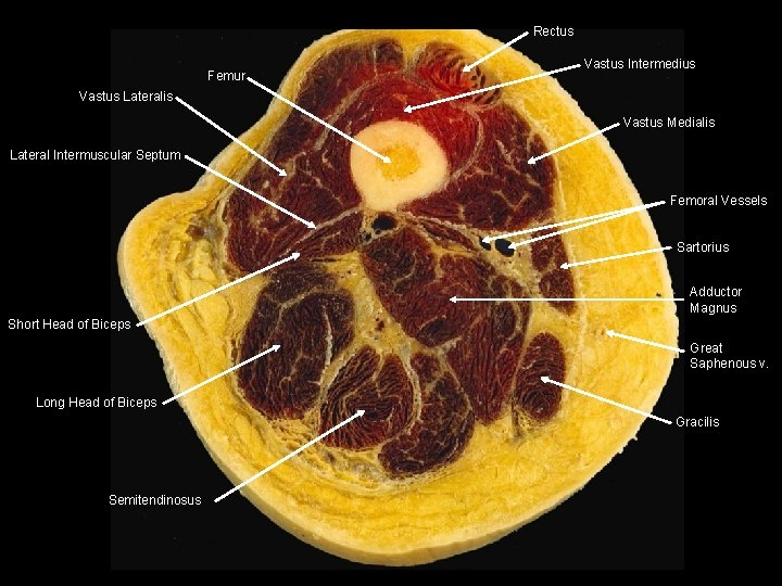 Rectus Femur Vastus Intermedius Vastus Lateralis Vastus Medialis Lateral Intermuscular Septum Femoral Vessels Sartorius Rectus Femur Vastus Intermedius Vastus Lateralis Vastus Medialis Lateral Intermuscular Septum Femoral Vessels Sartorius