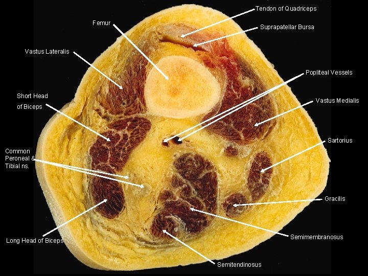 Tendon of Quadriceps Femur Suprapatellar Bursa Vastus Lateralis Popliteal Vessels Short Head Vastus Medialis Tendon of Quadriceps Femur Suprapatellar Bursa Vastus Lateralis Popliteal Vessels Short Head Vastus Medialis
