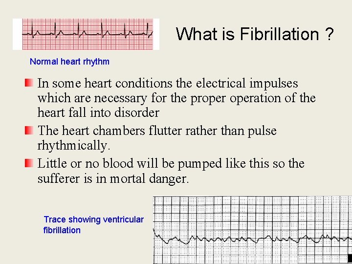 What is Fibrillation ? Normal heart rhythm In some heart conditions the electrical impulses