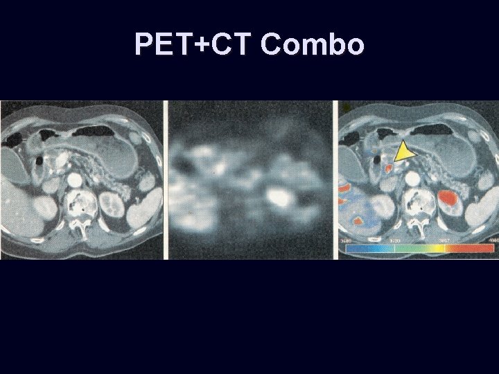 PET+CT Combo 