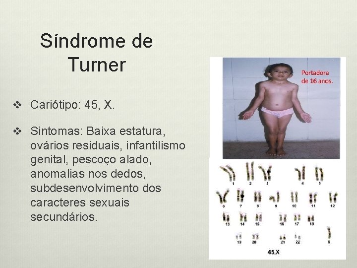 Síndrome de Turner v Cariótipo: 45, X. v Sintomas: Baixa estatura, ovários residuais, infantilismo