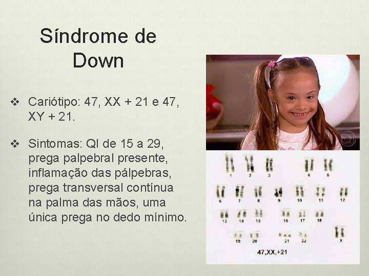 Síndrome de Down v Cariótipo: 47, XX + 21 e 47, XY + 21.