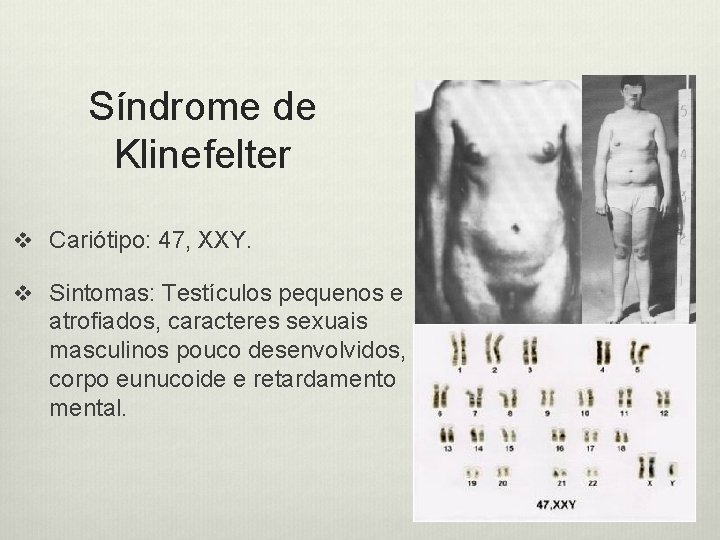 Síndrome de Klinefelter v Cariótipo: 47, XXY. v Sintomas: Testículos pequenos e atrofiados, caracteres