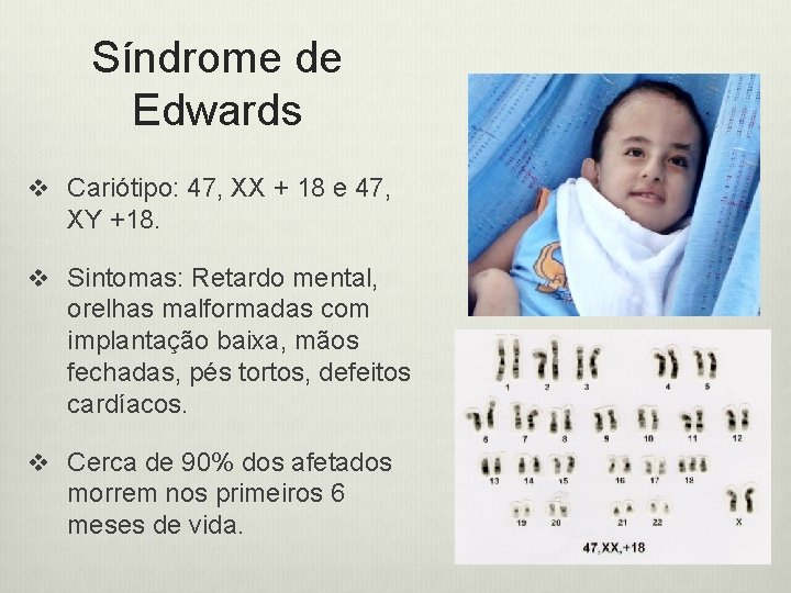 Síndrome de Edwards v Cariótipo: 47, XX + 18 e 47, XY +18. v