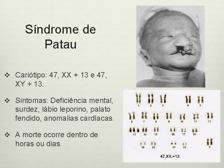 Síndrome de Patau v Cariótipo: 47, XX + 13 e 47, XY + 13.