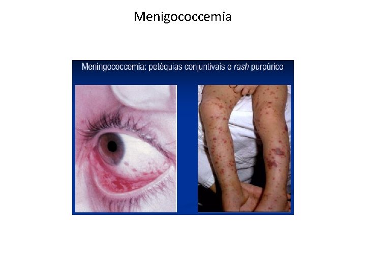 Menigococcemia 