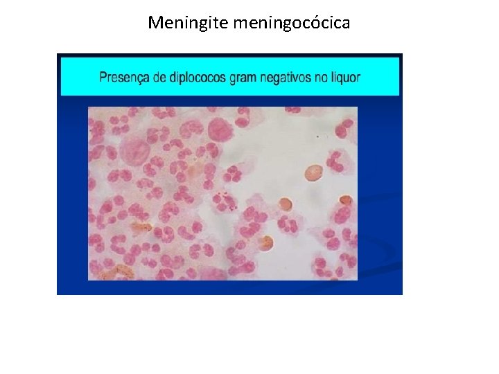 Meningite meningocócica 