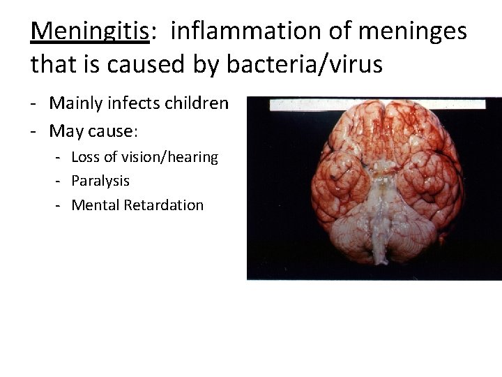 Meningitis: inflammation of meninges that is caused by bacteria/virus - Mainly infects children -