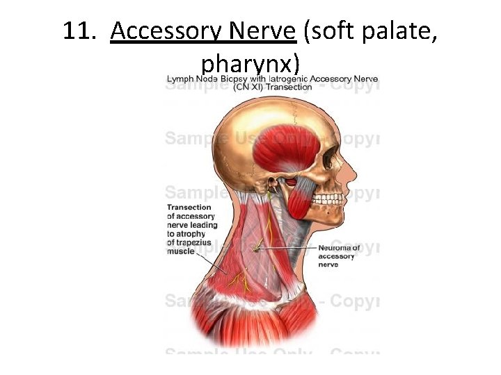 11. Accessory Nerve (soft palate, pharynx) 