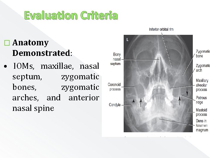Evaluation Criteria � Anatomy Demonstrated: • IOMs, maxillae, nasal septum, zygomatic bones, zygomatic arches,