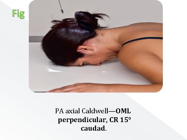 Fig PA axial Caldwell—OML perpendicular, CR 15° caudad. 