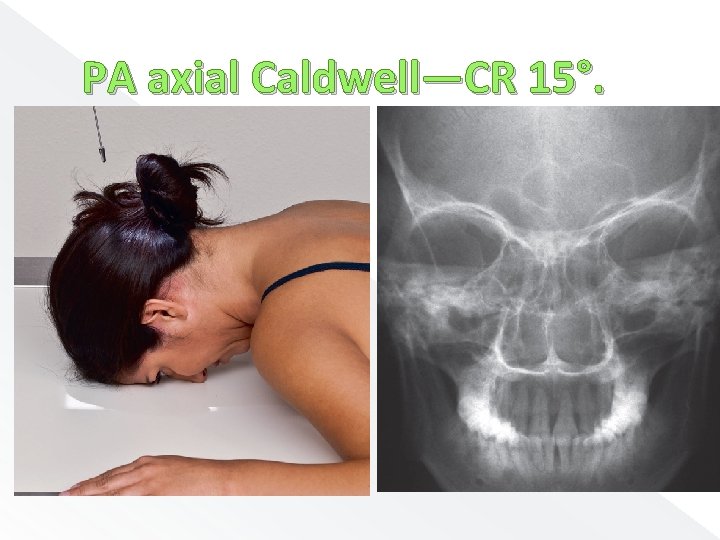 PA axial Caldwell—CR 15°. 