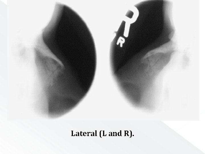 Lateral (L and R). 