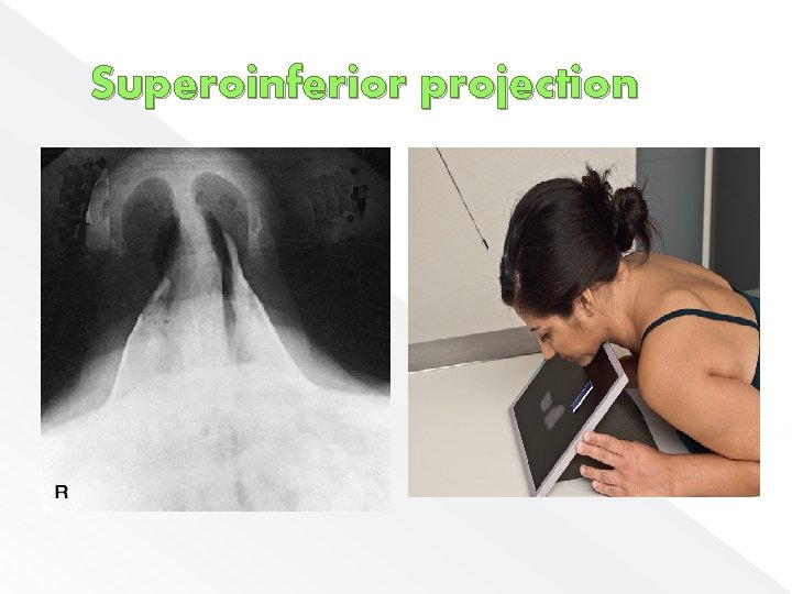 Superoinferior projection 