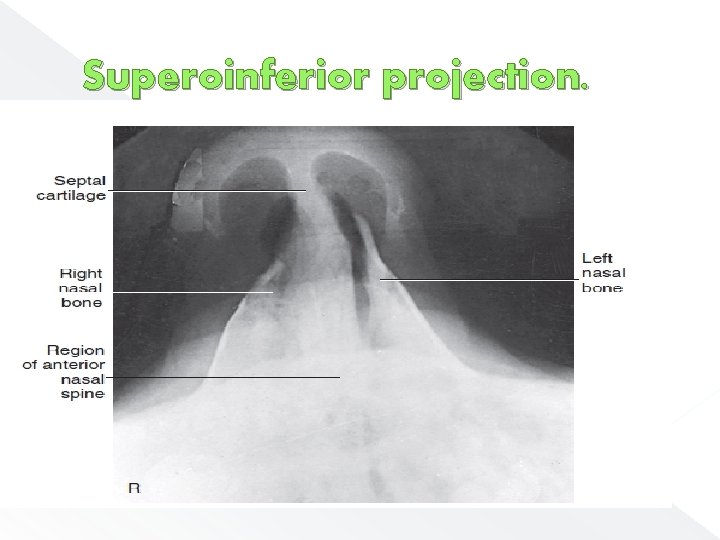 Superoinferior projection. 